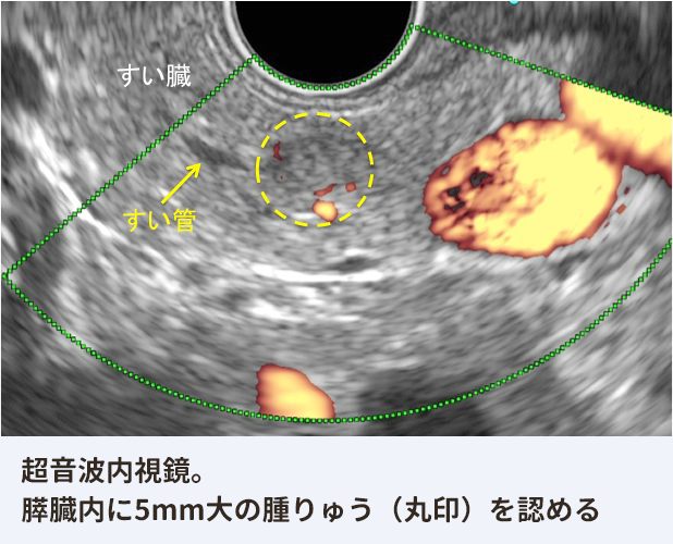 超音波内視鏡。すい臓内に5mm大の腫りゅう（丸印）を認める。
