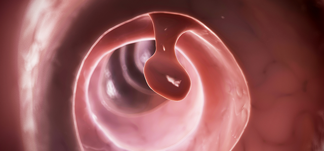 大腸ポリープのイメージ