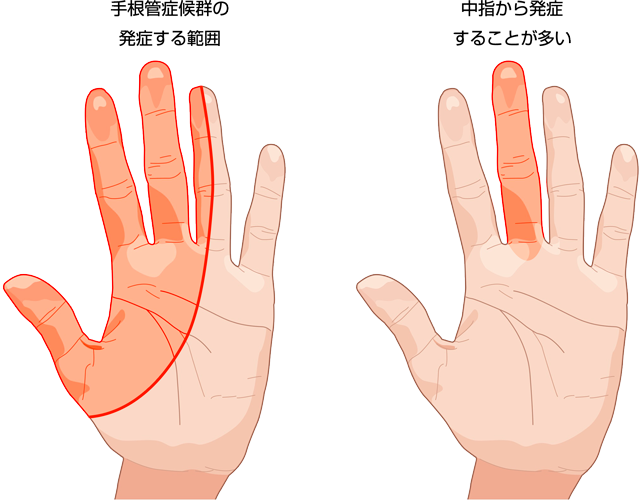指のしびれはどのように診断されますか?
