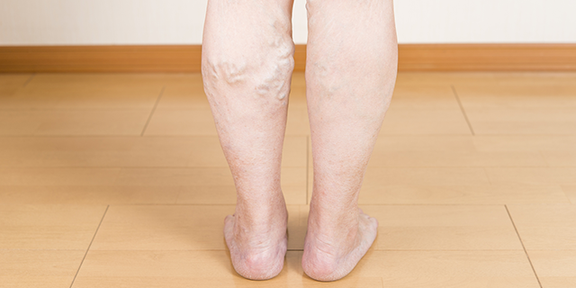 足がむくんでつらい 下肢静脈瘤とはどんな病気 メディカリスト